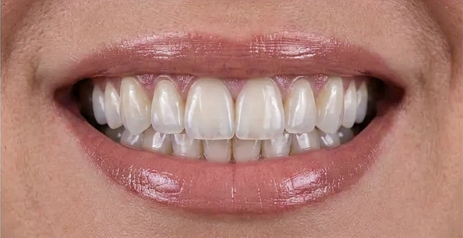 Avant implant dentaire Tanger