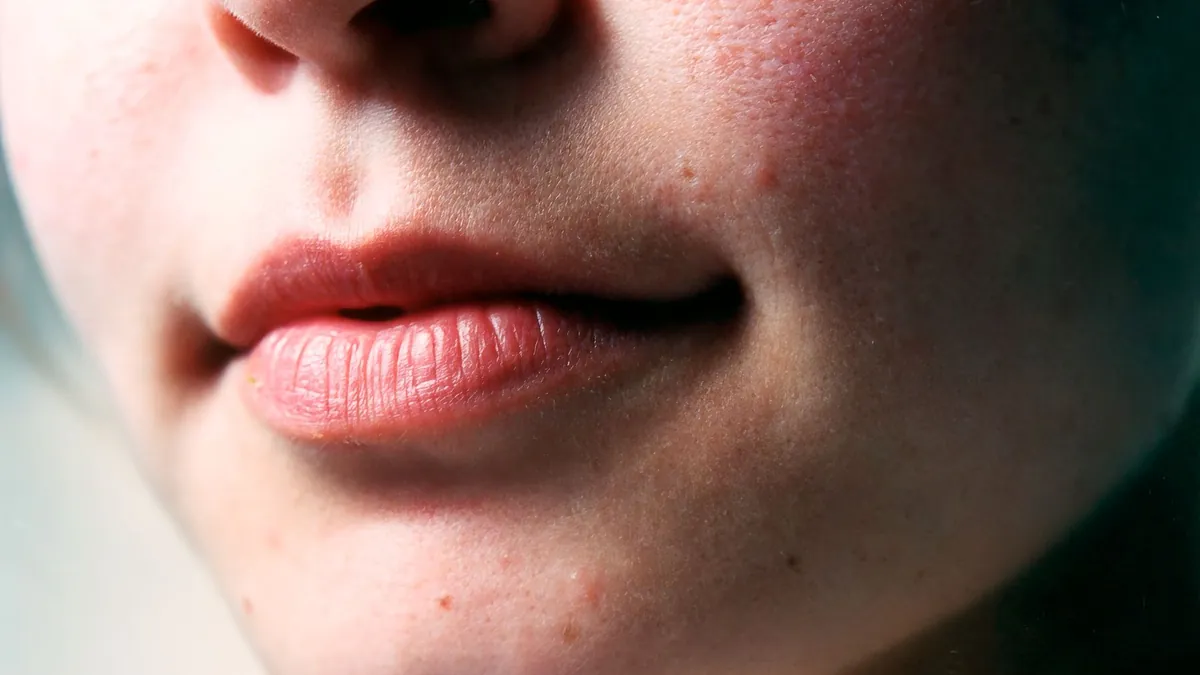 Bouche en gros plan : les aphtes touchent les muqueuses