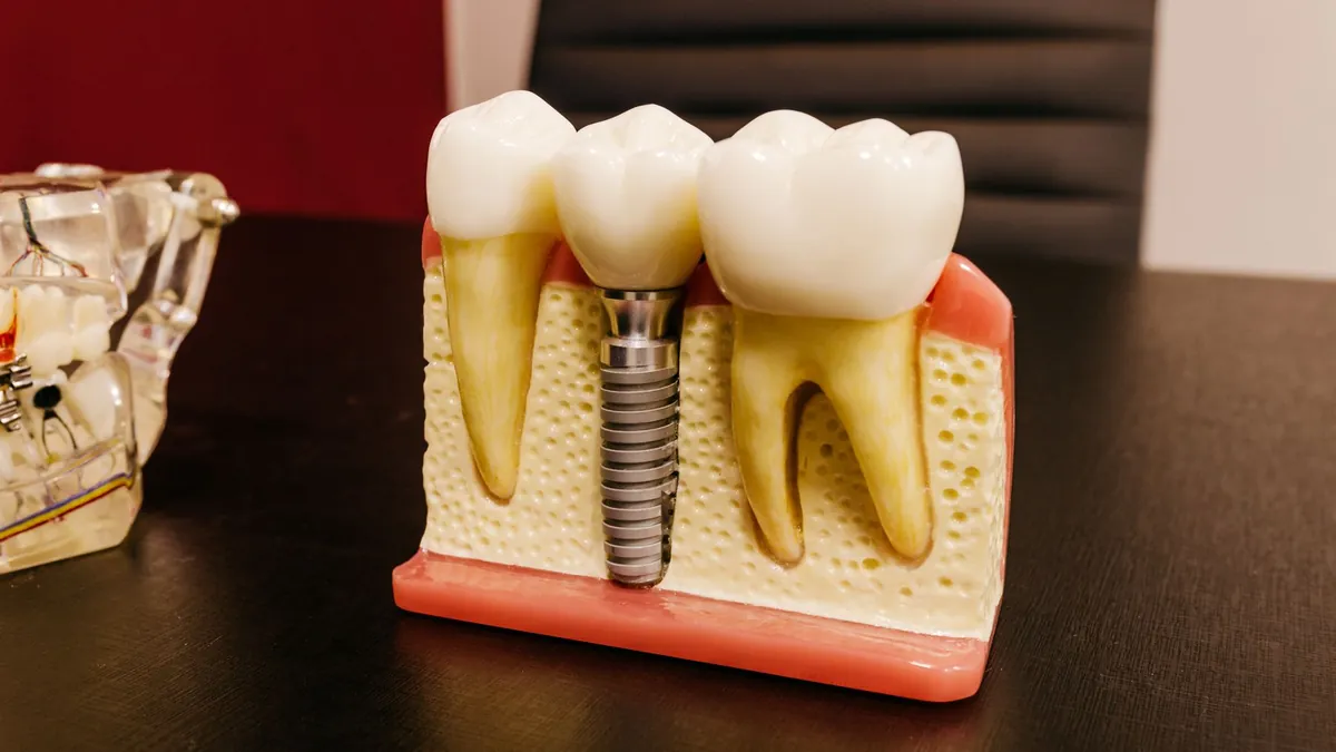 Implant dentaire : comprendre le prix