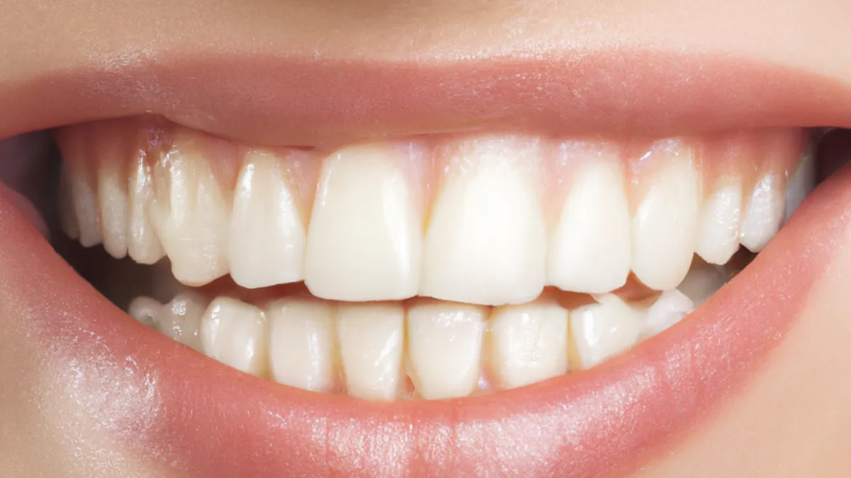 Sourire gingival