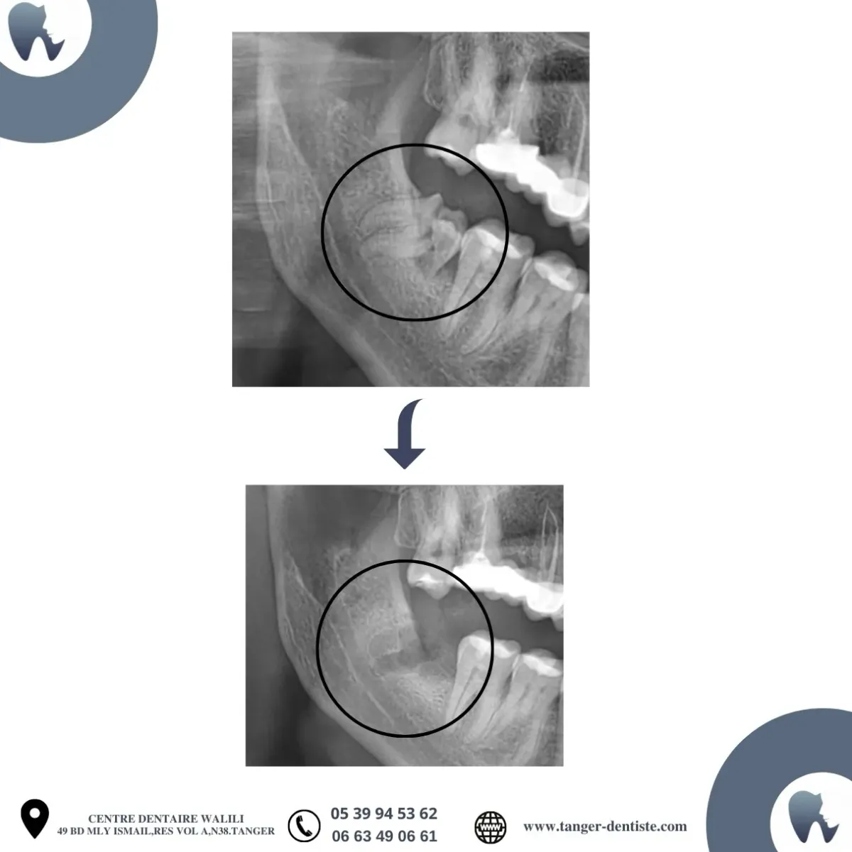 Radiographie dent de sagesse extraction Tanger
