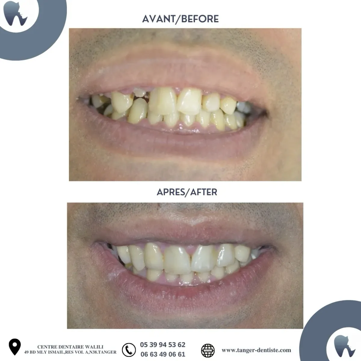 Réhabilitation sourire céramique Tanger avant après