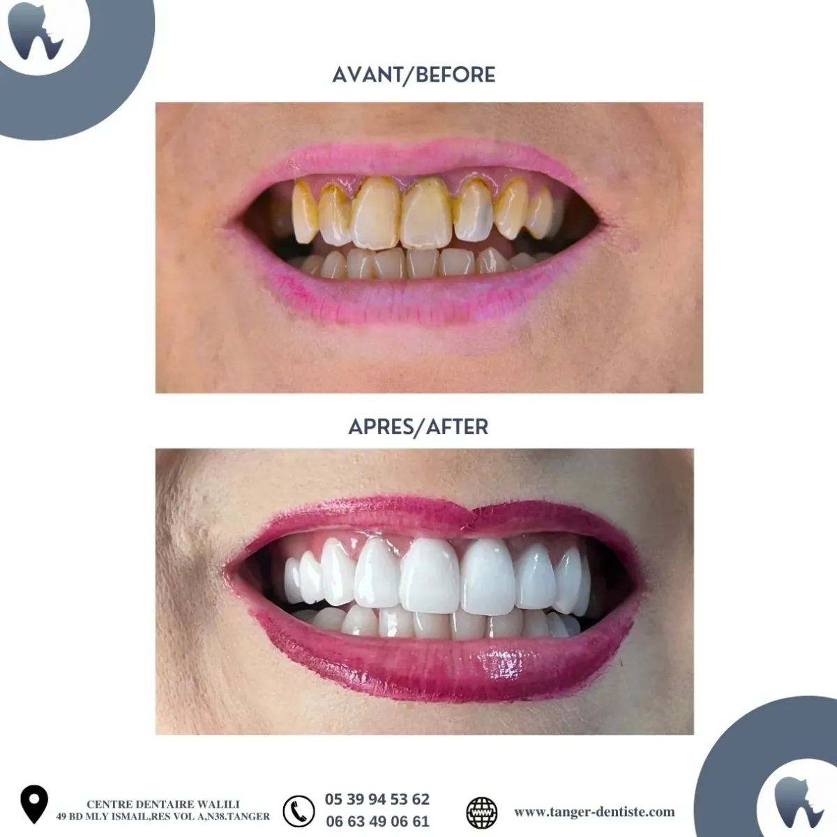 Réhabilitation sourire zircone céramique Tanger avant après