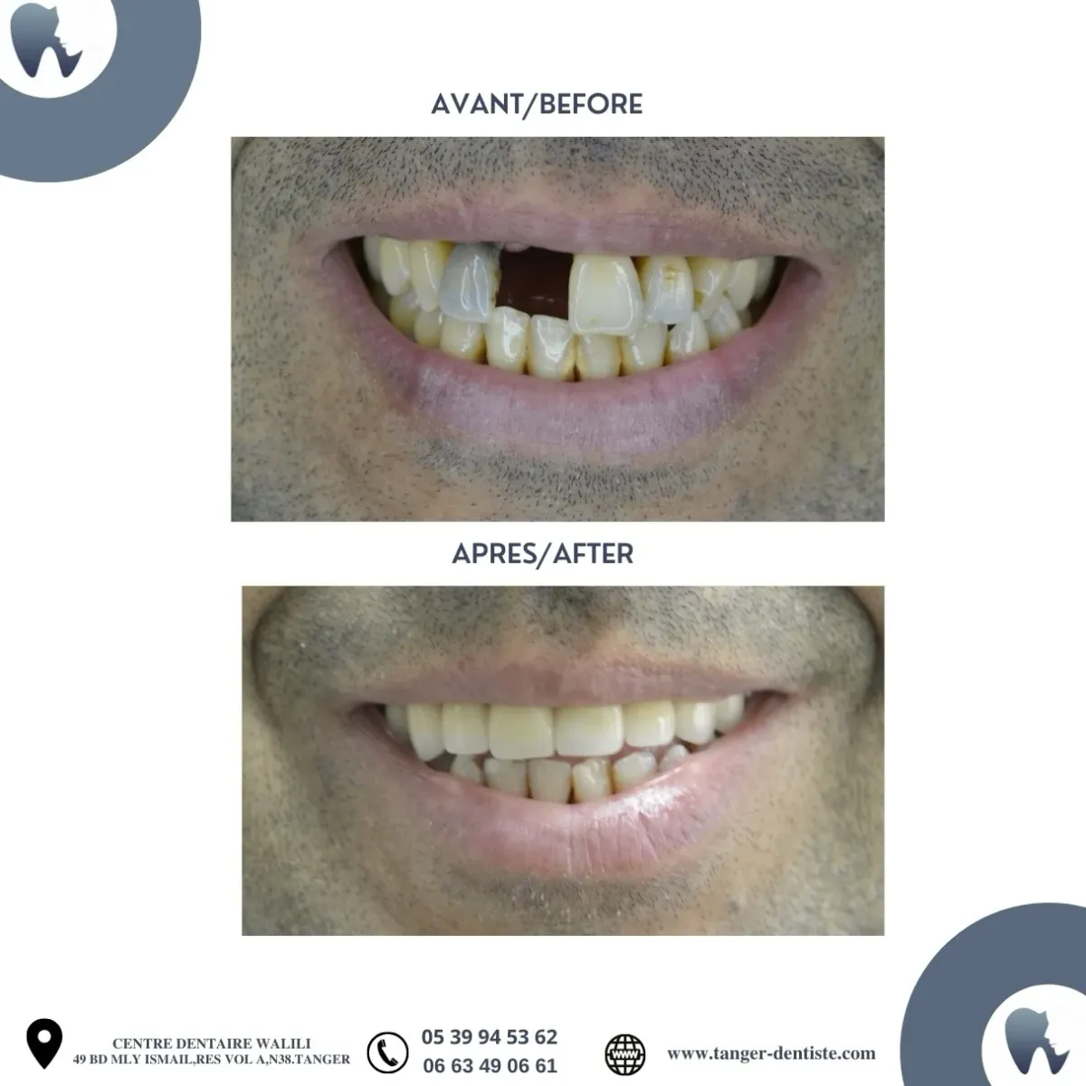 Réhabilitation sourire complète Tanger avant après