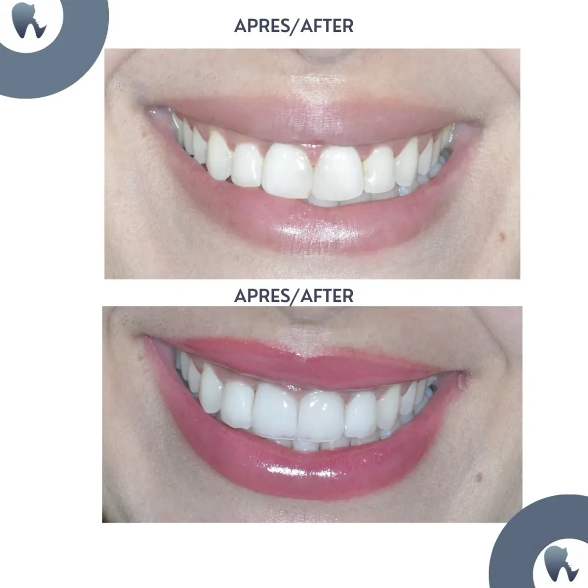 Réhabilitation sourire zircone Tanger avant après