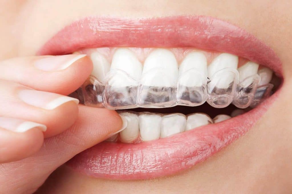 Quelles sont les types d’appareillage en orthodontie ?